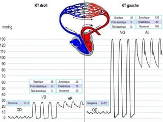 mmHg
0
10
20
30
40
50
60
70
80
90
100
110
120
130
OD
VD AP
VG Ao
OG
KT droit KT gauche
 