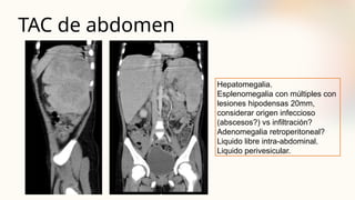 TAC de abdomen
Hepatomegalia.
Esplenomegalia con múltiples con
lesiones hipodensas 20mm,
considerar origen infeccioso
(abscesos?) vs infiltración?
Adenomegalia retroperitoneal?
Liquido libre intra-abdominal.
Liquido perivesicular.
 