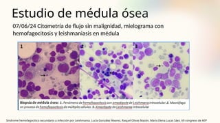 Estudio de médula ósea
07/06/24 Citometría de flujo sin malignidad, mielograma con
hemofagocitosis y leishmaniasis en médula
Síndrome hemofagocítico secundario a infección por Leishmania. Lucía González Álvarez, Raquel Olivas Mazón, María Elena Lucas Sáez. 69 congreso de AEP
 