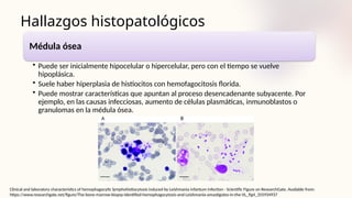 Hallazgos histopatológicos
Médula ósea
• Puede ser inicialmente hipocelular o hipercelular, pero con el tiempo se vuelve
hipoplásica.
• Suele haber hiperplasia de histiocitos con hemofagocitosis florida.
• Puede mostrar características que apuntan al proceso desencadenante subyacente. Por
ejemplo, en las causas infecciosas, aumento de células plasmáticas, inmunoblastos o
granulomas en la médula ósea.
Clinical and laboratory characteristics of hemophagocytic lymphohistiocytosis induced by Leishmania infantum infection - Scientific Figure on ResearchGate. Available from:
https://www.researchgate.net/figure/The-bone-marrow-biopsy-identified-hemophagocytosis-and-Leishmania-amastigotes-in-the-VL_fig4_355934937
 