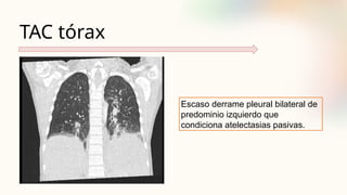 TAC tórax
Escaso derrame pleural bilateral de
predominio izquierdo que
condiciona atelectasias pasivas.
 