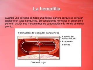 La hemofilia.
Cuando una persona se hace una herida, sangra porque se corta un
capilar o un vaso sanguíneo. En condiciones normales el organismo
pone en acción sus mecanismos de coagulación y la herida se cierra
pronto.
 