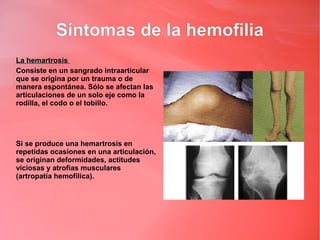 Síntomas de la hemofilia
La hemartrosis
Consiste en un sangrado intraarticular
que se origina por un trauma o de
manera espontánea. Sólo se afectan las
articulaciones de un solo eje como la
rodilla, el codo o el tobillo.




Si se produce una hemartrosis en
repetidas ocasiones en una articulación,
se originan deformidades, actitudes
viciosas y atrofias musculares
(artropatía hemofílica).
 