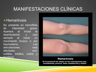 MANIFESTACIONES CLÍNICAS
Hemartrosis
Se presenta en hemofilias
de intensidad grave.
Aparece al iniciar la
deambulación y casi
siempre al hacer un
movimiento brusco o por
traumatismo. Las
articulaciones mas
afectadas son:
rodillas, tobillos, codos y
hombros.
 