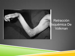 Retracción
Isquémica De
Volkman
 