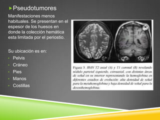 Pseudotumores
Manifestaciones menos
habituales. Se presentan en el
espesor de los huesos en
donde la colección hemática
esta limitada por el periostio.
Su ubicación es en:
• Pelvis
• Cráneo
• Pies
• Manos
• Costillas
 