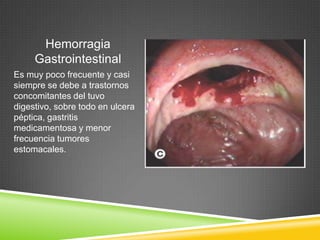Hemorragia
Gastrointestinal
Es muy poco frecuente y casi
siempre se debe a trastornos
concomitantes del tuvo
digestivo, sobre todo en ulcera
péptica, gastritis
medicamentosa y menor
frecuencia tumores
estomacales.
 