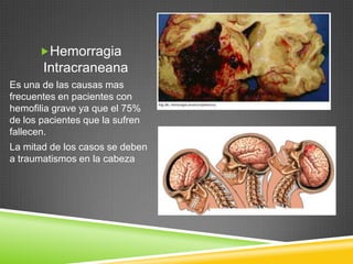 Hemorragia
Intracraneana
Es una de las causas mas
frecuentes en pacientes con
hemofilia grave ya que el 75%
de los pacientes que la sufren
fallecen.
La mitad de los casos se deben
a traumatismos en la cabeza
 