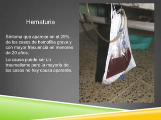 Hematuria
Síntoma que aparece en el 25%
de los casos de hemofilia grave y
con mayor frecuencia en menores
de 20 años.
La causa puede ser un
traumatismo pero la mayoría de
los casos no hay causa aparente.
 