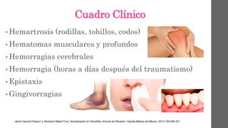 Cuadro Clínico
• Hemartrosis (rodillas, tobillos, codos)
• Hematomas musculares y profundos
• Hemorragias cerebrales
• Hemorragia (horas a días después del traumatismo)
• Epistaxis
• Gingivorragias
Jaime García-Chávez1 y Abraham Majluf-Cruz. Actualización en Hemofilia. Artículo de Revisión. Gaceta Médica de México. 2013;149:308-321
 