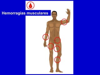 Hemorragias musculares 