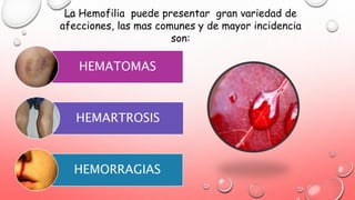 La Hemofilia puede presentar gran variedad de
afecciones, las mas comunes y de mayor incidencia
son:
HEMATOMAS
HEMARTROSIS
HEMORRAGIAS
 