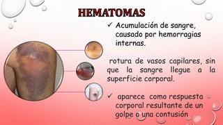  Acumulación de sangre,
causado por hemorragias
internas.
rotura de vasos capilares, sin
que la sangre llegue a la
superficie corporal.
 aparece como respuesta
corporal resultante de un
golpe o una contusión
 