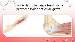 Si no se trata la hemartosis puede
provocar Dolor articular grave.
 