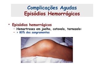 • Episódios hemorrágicos
– Hemartroses em joelho, cotovelo, tornozelo:
– > 80% dos sangramentos
Complicações Agudas (1)
Complicações Agudas
Episódios Hemorrágicos
 