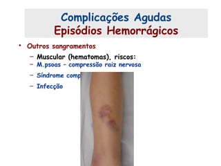 • Outros sangramentos
– Muscular (hematomas), riscos:
– M.psoas – compressão raiz nervosa
– Síndrome compartimental
– Infecção
Complicações Agudas (2)
Complicações Agudas
Episódios Hemorrágicos
 
