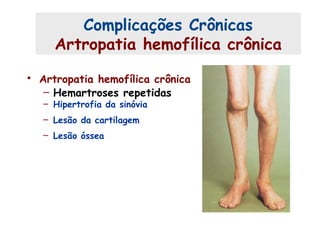 • Artropatia hemofílica crônica
– Hemartroses repetidas
– Hipertrofia da sinóvia
– Lesão da cartilagem
– Lesão óssea
Complicações Crônicas
Artropatia hemofílica crônica
 