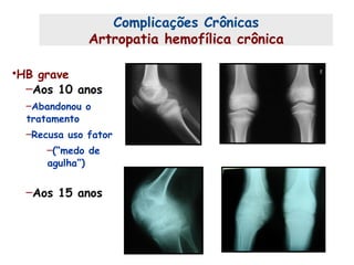 Complicações Crônicas
Artropatia hemofílica crônica
•HB grave
–Aos 10 anos
–Abandonou o
tratamento
–Recusa uso fator
–(“medo de
agulha”)
–Aos 15 anos
 