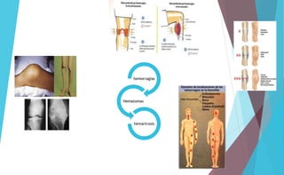 hemorragias 
Hematomas 
hemartrosis 
 