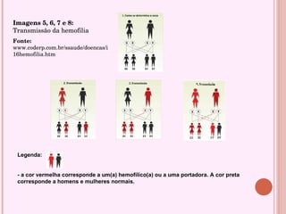 Legenda: - a cor vermelha corresponde a um(a) hemofílico(a) ou a uma portadora. A cor preta corresponde a homens e mulheres normais. Imagens 5, 6, 7 e 8:  Transmissão da hemofilia Fonte:  www.coderp.com.br/ssaude/doencas/i16hemofilia.htm 
