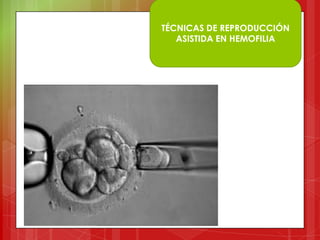 TÉCNICAS DE REPRODUCCIÓN
ASISTIDA EN HEMOFILIA
 