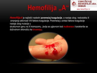 Hemofilija A-B sanja ilic I5 | PPT