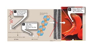 3 Intracellular fibers
of HbS dis tort
the erythrocyte.
1
Hyd ro p h o b ic
p o c k e t
Fib e r
Fib e rs
β-6 -Va lin e
β Chain
A point mutation
in the DNA codes
for s tructurally
altered HbS.
2
In the deoxygenated
s tate, HbS
polymerizes
into long, rope-like
fibers .
...GTG...
...GAG...
Val.His.Leu.Thr.Pro.Glu .Glu.Lys
Val.His.Leu.Thr.Pro.Va l.Glu.Lys
Rigid erythrocytes
occlude blood flow
in the capillaries .
4
α1
α2
β1
β2
α1
α2
β1
β2
α1
α2
β1
β2
α1
α2
β1
β2
IV. Hemoglobinopathies 37
which decreases RBC sickling. This leads to decreased frequency
of painful crises and reduces mortality. [Note: The morbidity and
mortality associated with sickle cell anemia has led to its inclu-
sion in newborn screening panels to allow prophylactic antibiotic
3 Intracellular fibers
of HbS dis tort
the erythrocyte.
1
Hyd ro p h o b ic
p o c k e t
Fib e r
Fib e rs
β-6 -Va lin e
β Chain
A point mutation
in the DNA codes
for s tructurally
altered HbS.
2
In the deoxygenated
s tate, HbS
polymerizes
into long, rope-like
fibers .
TG...
...GAG...
.His.Leu.Thr.Pro.Glu .Glu.Lys
.His.Leu.Thr.Pro.Va l.Glu.Lys
Rigid erythrocytes
occlude blood flow
in the capillaries .
4
α1
α2
β1
β2
α1
α2
β1
β2
α1
α2
β1
β2
α1
α2
β1
β2
Hemoglobinopathies 37
which decreases RBC sickling. This leads to decreased frequency
 
