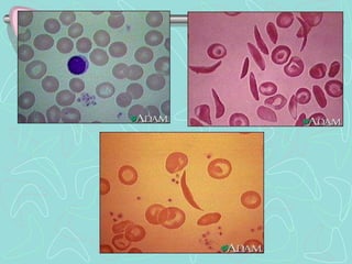 Hemoglobinopathies