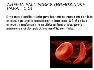 ANEMIA FALCIFORME (HOMOZIGOSE
PARA HB S)
É uma anemia hemolítica crônica grave decorrente do encurtamento da vida do
eritrócito. A presença de hemoglobina F em homozigose (SS-βs/βs) induz os
eritrócitos a transformarem-se em células em forma de foice, que são
prontamente destruídas pelo sistema monofítico-macrofágico.
 