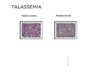 Hemácias normais. Hemácias em alvo
TALASSEMIA
 