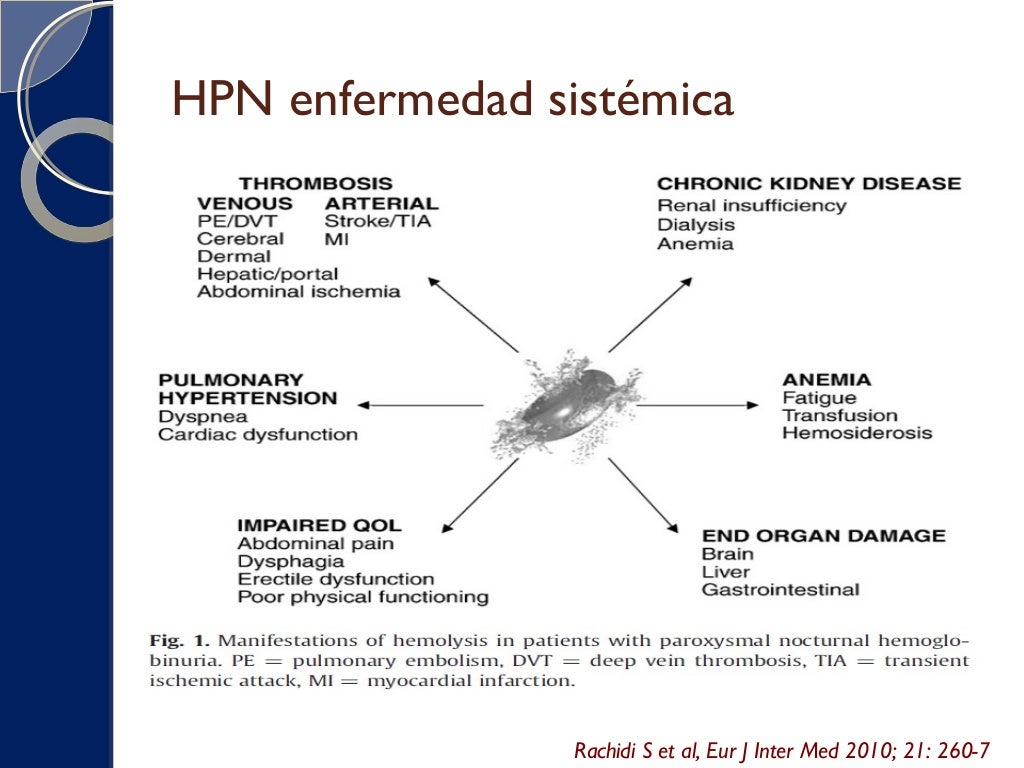 Hemoglobinuria paroxistica nocturna