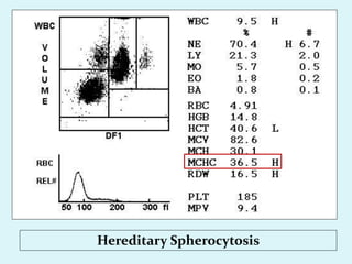 Hereditary Spherocytosis
 