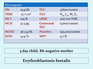 Hemogram
Hb 15 g/dL TLC 47600/cumm
TRBC 5.1 x 106 DLC N45 L50 M2 E3
MCV 109 fL nRBC 200/100 WBC
MCH 31.5 pg Corrected
TLC
15,600/cumm
MCHC 36.3 g/dL Platelet: 293,000/cumm
RDW 14.9 % MPV 9.7 fL
5 day child, Rh negative mother
Erythroblastosis foetalis
 