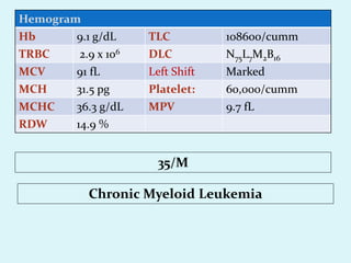 Hemogram
Hb 9.1 g/dL TLC 108600/cumm
TRBC 2.9 x 106 DLC N75L7M2B16
MCV 91 fL Left Shift Marked
MCH 31.5 pg Platelet: 60,000/cumm
MCHC 36.3 g/dL MPV 9.7 fL
RDW 14.9 %
Chronic Myeloid Leukemia
35/M
 