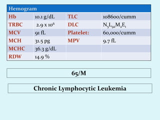 Hemogram
Hb 10.1 g/dL TLC 108600/cumm
TRBC 2.9 x 106 DLC N5L92M2E1
MCV 91 fL Platelet: 60,000/cumm
MCH 31.5 pg MPV 9.7 fL
MCHC 36.3 g/dL
RDW 14.9 %
Chronic Lymphocytic Leukemia
65/M
 