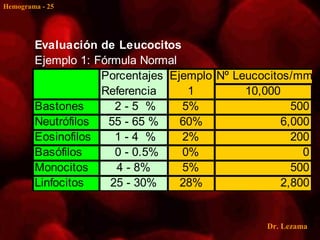 Hemograma - 25




        Evaluación de Leucocitos
        Ejemplo 1: Fórmula Normal
                    Porcentajes Ejemplo Nº Leucocitos/mm3
                    Referencia     1         10,000
        Bastones       2-5 %      5%                  500
        Neutrófilos  55 - 65 %    60%               6,000
        Eosinofilos    1-4 %      2%                  200
        Basófilos      0 - 0.5%   0%                    0
        Monocitos      4 - 8%     5%                  500
        Linfocitos    25 - 30%    28%               2,800


                                                Dr. Lezama
 