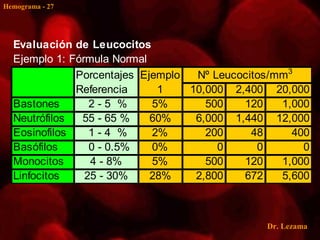 Hemograma - 27




  Evaluación de Leucocitos
  Ejemplo 1: Fórmula Normal
              Porcentajes Ejemplo  Nº Leucocitos/mm3
              Referencia     1    10,000 2,400 20,000
  Bastones       2-5 %      5%       500   120    1,000
  Neutrófilos  55 - 65 %    60%    6,000 1,440 12,000
  Eosinofilos    1-4 %      2%       200     48     400
  Basófilos      0 - 0.5%   0%         0      0       0
  Monocitos      4 - 8%     5%       500   120    1,000
  Linfocitos    25 - 30%    28%    2,800   672    5,600



                                               Dr. Lezama
 