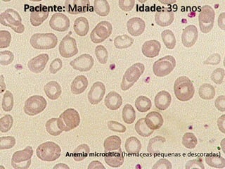 Paciente: Maria Idade: 39 anos
Anemia microcítica (hemáceas pequenas e descoradas)
 
