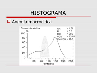 HISTOGRAMA
 Anemia macrocítica
 