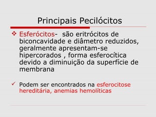 Principais Pecilócitos
 Esferócitos- são eritrócitos de
biconcavidade e diâmetro reduzidos,
geralmente apresentam-se
hipercorados , forma esferocítica
devido a diminuição da superfície de
membrana
 Podem ser encontrados na esferocitose
hereditária, anemias hemolíticas
 