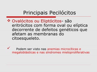  Ovalócitos ou Eliptócitos- são
eritrócitos com forma oval ou elíptica
decorrente de defeitos genéticos que
afetam as membranas do
citoesqueleto.
 Podem ser visto nas anemias microcíticas e
megaloblásticas e nas síndromes mieloproliferativas
Principais Pecilócitos
 