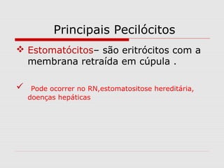 Principais Pecilócitos
 Estomatócitos– são eritrócitos com a
membrana retraída em cúpula .
 Pode ocorrer no RN,estomatositose hereditária,
doenças hepáticas
 