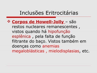  Corpos de Howell-Jolly – são
restos nucleares remanescentes ,
vistos quando há hipofunção
esplênica , pela falta de função
filtrante do baço. Vistos também em
doenças como anemias
megaloblásticas , mielodisplasias, etc.
Inclusões Eritrocitárias
 