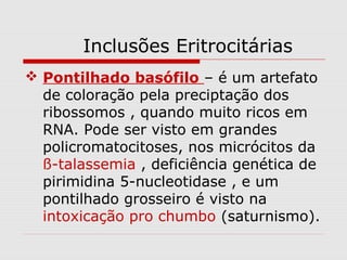 Inclusões Eritrocitárias
 Pontilhado basófilo – é um artefato
de coloração pela preciptação dos
ribossomos , quando muito ricos em
RNA. Pode ser visto em grandes
policromatocitoses, nos micrócitos da
ß-talassemia , deficiência genética de
pirimidina 5-nucleotidase , e um
pontilhado grosseiro é visto na
intoxicação pro chumbo (saturnismo).
 