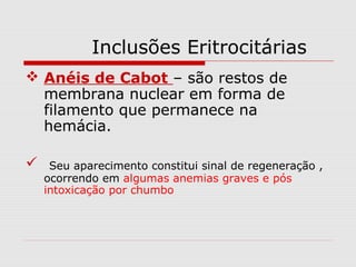 Inclusões Eritrocitárias
 Anéis de Cabot – são restos de
membrana nuclear em forma de
filamento que permanece na
hemácia.
 Seu aparecimento constitui sinal de regeneração ,
ocorrendo em algumas anemias graves e pós
intoxicação por chumbo
 