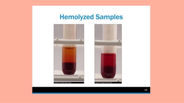 How Can You Visually Tell Serum From Plasma During The Process Of how-can-you-visually-tell-serum-from-plasma-during-the-process-of