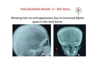 THALASSAEMIA MAJOR : X – RAY SKULL
Showing Hair on end appearance due to increased diploic
space in the skull bones
 