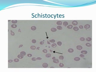 Schistocytes
 