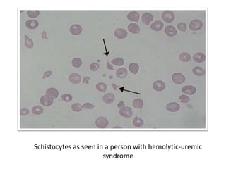 Schistocytes as seen in a person with hemolytic-uremic
syndrome
 