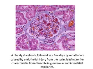 A bloody diarrhea is followed in a few days by renal failure
caused by endothelial injury from the toxin, leading to the
characteristic fibrin thrombi in glomerular and interstitial
capillaries.
 
